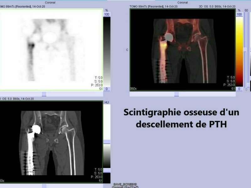 scinti_pre-op_spacer_cardella_1