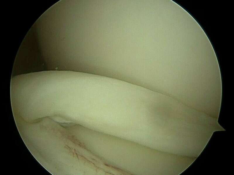 brakha_jeremy_arthroscopiedegenou_2021-05-20-085119__surgeon_still_002