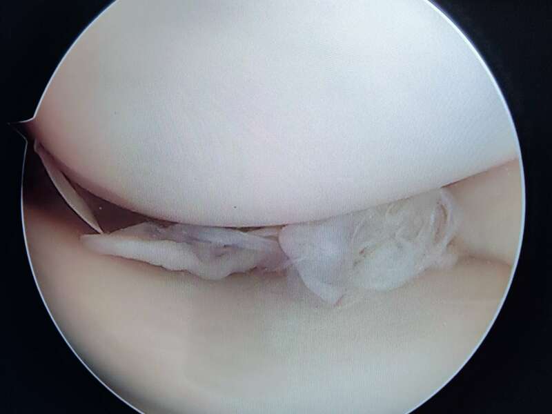 menisque_degeneratif_2