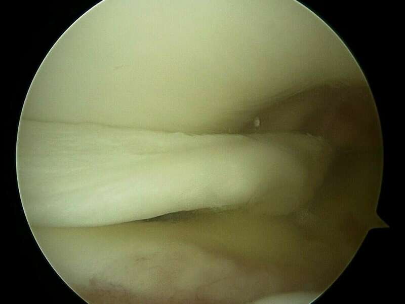 brakha_jeremy_arthroscopiedegenou_2021-05-20-085119__surgeon_still_003