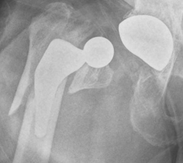 Fracture sur Prothèse