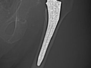 luxation_pih_hanche_face