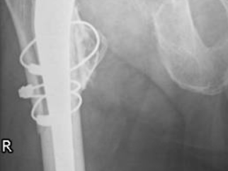 luxation_pth_hanche_face