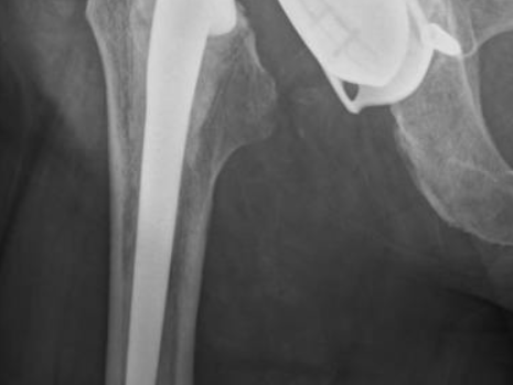 luxation_intra-prothetique_hanche_face