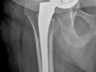 deplacement_cotyle_hanche_face