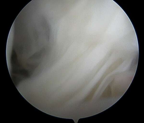 Arthrolyse arthroscopique