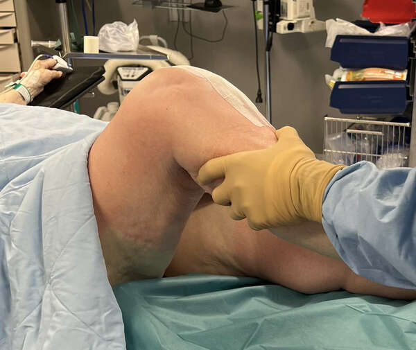 Mobilisation sous anesthésie générale