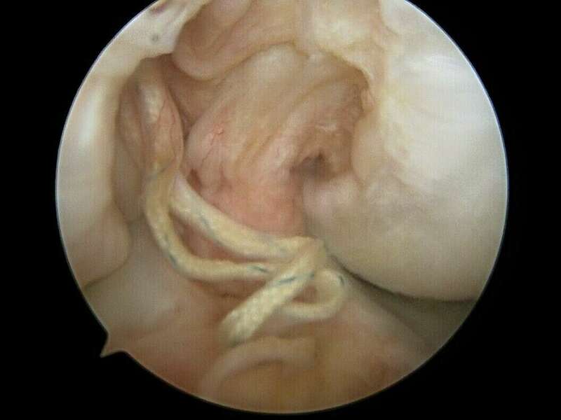 arthro_rerupture_lca_2