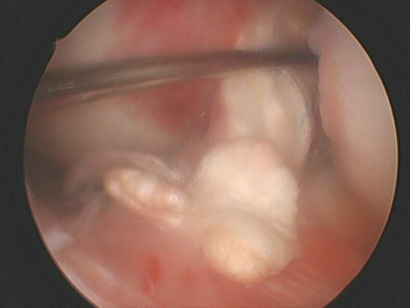 arthro_rerupture_lca