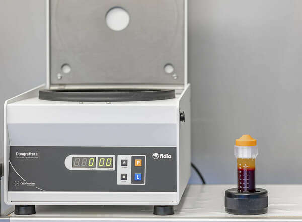 Injections intra-osseuses de plasma riche en plaquettes (PRP) dans l'arthrose avancée du genou