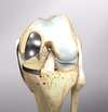 Prothèse Uni-Compartimentale de Genou