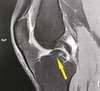 diagnostic d'une rupture ligamentaire du genou