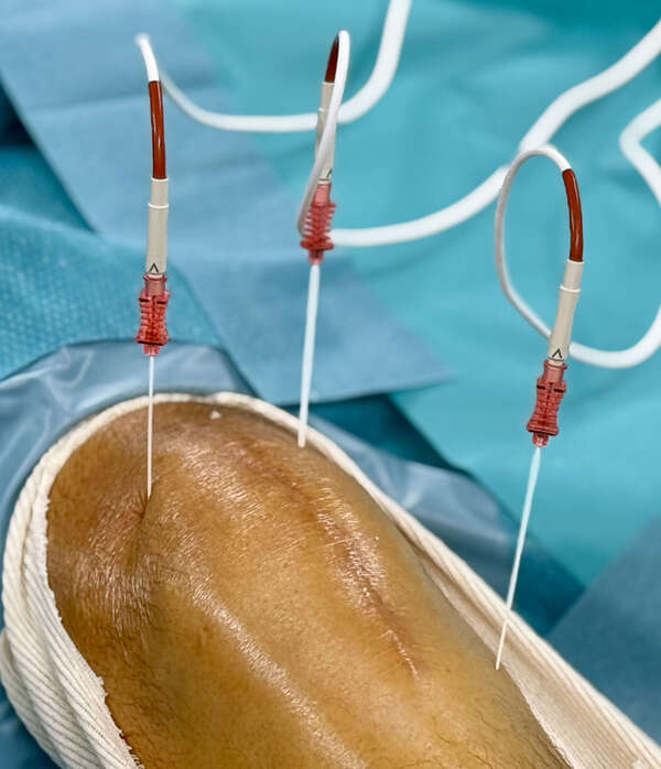 Prothèse de genou douloureuse : la thermocoagulation des nerfs géniculés à Marseille