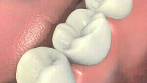 Pose d'implants et couronnes