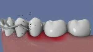 Traitement ultrasonique de la parodontite