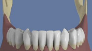 Mandibule : Bridge complet scellé sans fausse gencive