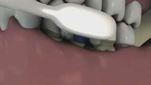 Impact du brossage agressif sur l’usure des dents
