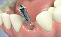 IMPLANTS DENTAIRES