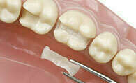 Onlay dentaire