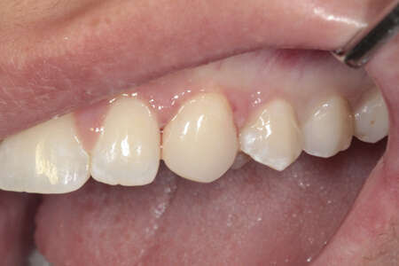 COMPOSITES DENTAIRES