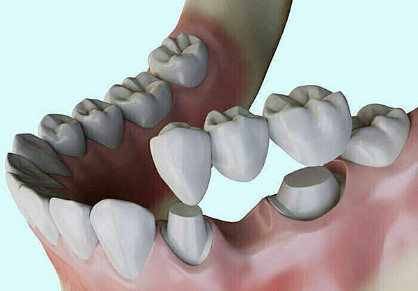LES BRIDGES ET PONTS DENTAIRES