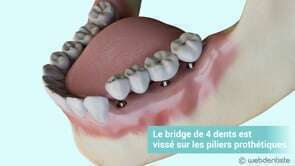 Bridge transvissé 4 dents