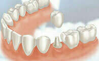 Couronnes et bridges dentaires