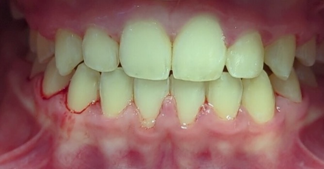 Traitement orthodontique, Patient de 9 ans, Cabinet du Dr Bankowska Adrianna, Auvers-sur-Oise.
