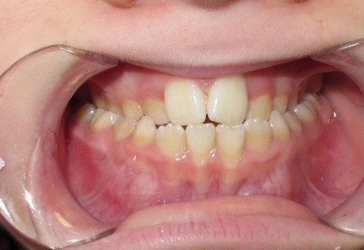 Traitement orthodontique, Patient de 9 ans, Cabinet du Dr Bankowska Adrianna, Auvers-sur-Oise.
