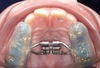 Traitement orthodontique : disjoncteur maxillaire orthopédique, Cabinet du Dr Bankowska Adrianna, Auvers-sur-Oise.