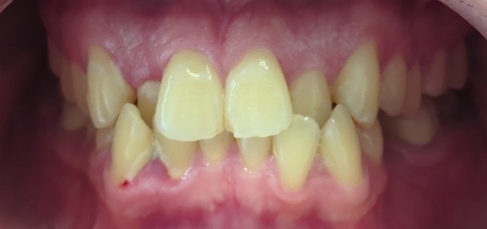 Traitement orthodontique : disjoncteur maxillaire orthopédique, Cabinet du Dr Bankowska Adrianna, Auvers-sur-Oise.