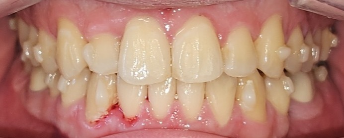 Traitement orthodontique : disjoncteur maxillaire orthopédique, Cabinet du Dr Bankowska Adrianna, Auvers-sur-Oise.