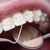 Traitement orthodontique actif, Auvers-sur-Oise