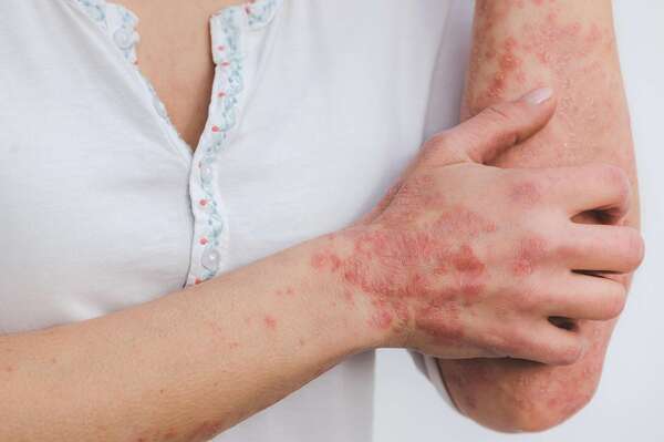 Le zona est une infection virale douloureuse, le magnétisme peut soulager les douleurs de zona
