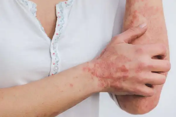 Le zona est une infection virale douloureuse, le magnétisme peut soulager les douleurs de zona