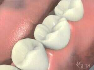 ￼Couronne sur implant dentaire