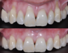 Chirurgie muco-gingivale, cas n°10