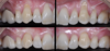 Chirurgie muco-gingivale, cas n°11