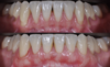 Chirurgie muco-gingivale, cas n°8