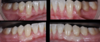 Chirurgie muco-gingivale, cas n°9
