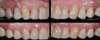 Chirurgie muco-gingivale, cas n°2 : avant et 3 mois après l'intervention