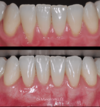 Chirurgie muco-gingivale, cas n°3 : avant et 3 mois après l'intervention