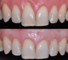 Chirurgie muco-gingivale, cas n°4 : avant et 3 mois après l'intervention