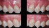 Chirurgie muco-gingivale, cas n°5 : avant et 3 mois après l'intervention