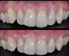 Chirurgie muco-gingivale, cas n°7