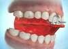 Activateur monobloc