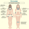 Schéma des 18 points de pression de la fibromyalgie