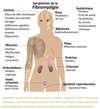 Schéma décrivant les symptômes de la fibromyalgie