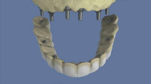 Maxillaire : bridge complet scellé sans fausse gencive