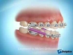 Overbite Correction in Braces